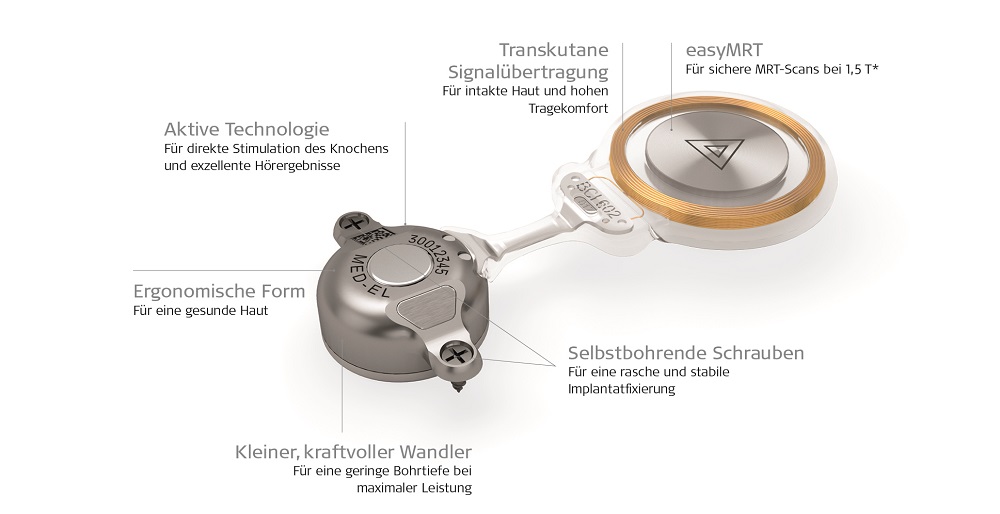 MED-EL präsentiert die nächste Generation seines Knochenleitungsimplantats: BONEBRIDGE BCI 602