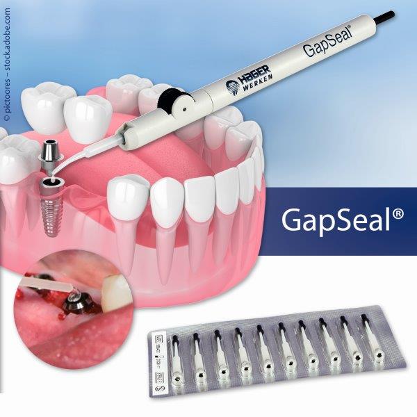 Microleakage bei Implantaten stoppen