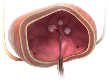 biolitec®: Treatment of bladder tumors now with trans-urethral laser ablation TULA® on an outpatient basis