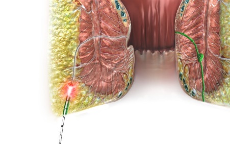 Laser therapy FiLaC® by biolitec® as one of the last ways for sphincter-protecting methods in complex perianal fistulas