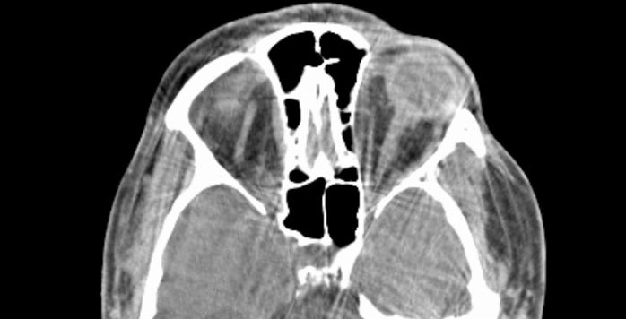 Neurochirurg für Köln: Aneurysma – OP ja oder nein?