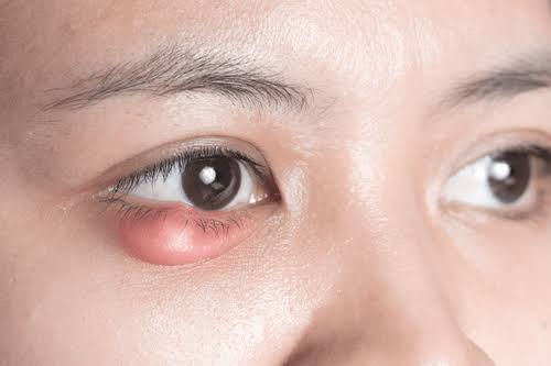 Stye – Know the Causes, Treatment & Home Remedies