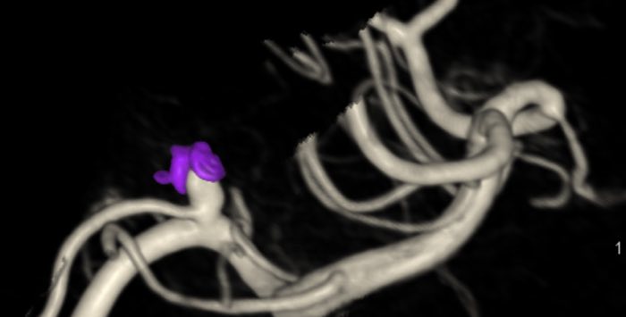 Hirntumor im Hybrid-OP für den Raum Köln behandeln