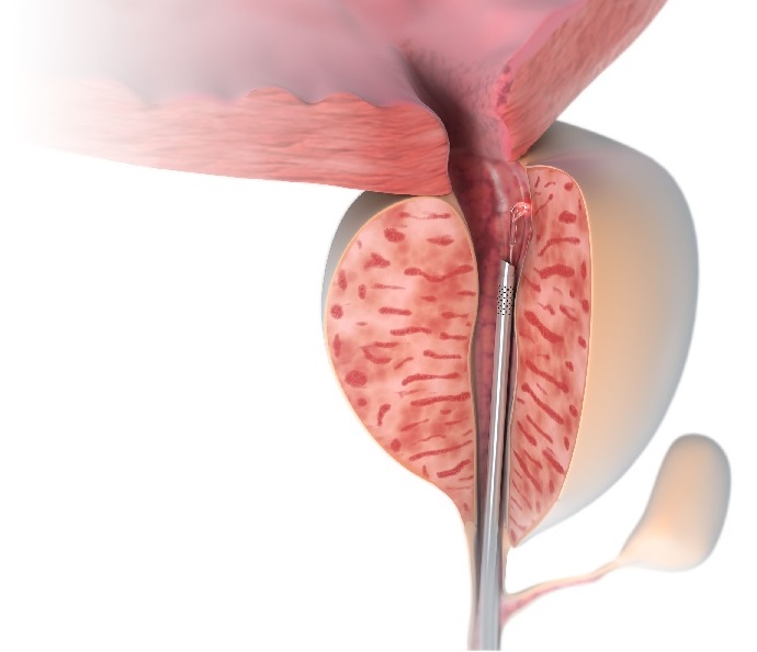 Prostata-Laser-Therapie LIFE: Infektionsarm – Schnell – Schonend – Risikopatienten geeignet