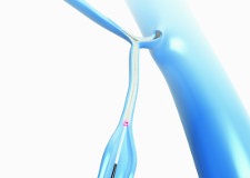 Gesunde und schöne Beine im neuen Jahr 2021 – Krampfadern mit innovativer Lasertherapie behandeln