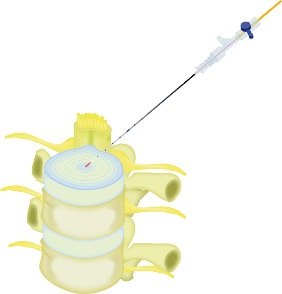biolitec®: Mikrochirurgische Laserbehandlung bei Bandscheibenvorfall vermindert erfolgreich intra-diskalen Druck und Schmerzen