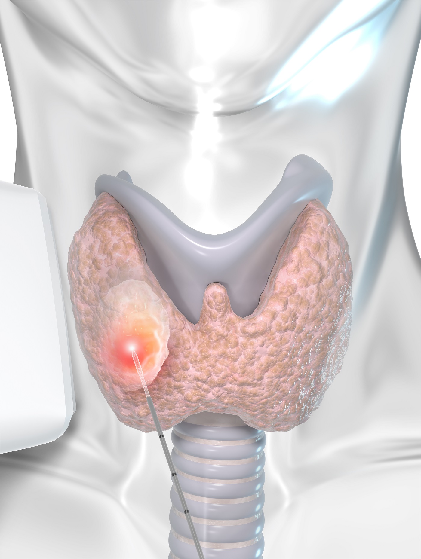 biolitec präsentiert neue ThyLA DUAL Lasertherapie bei gutartigen Schilddrüsenknoten