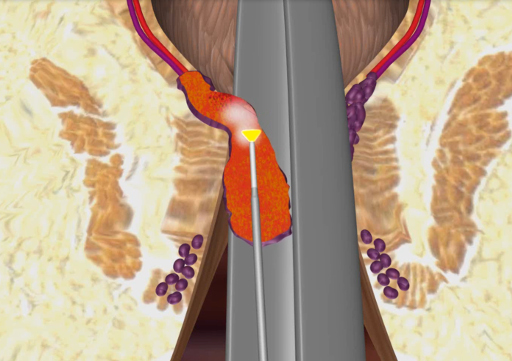 biolitec: Komplizierte Hämorrhoiden 3. und 4. Grades erfolgreich mit Lasertherapie LHP behandeln