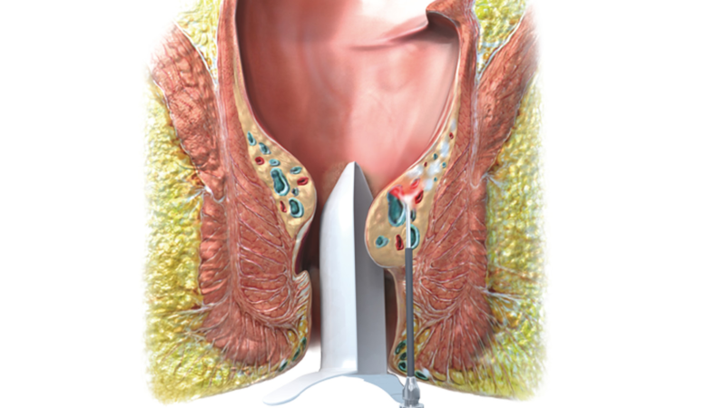 biolitec: Successful treatment of complicated 3rd and 4th degree haemorrhoids with LHP laser therapy