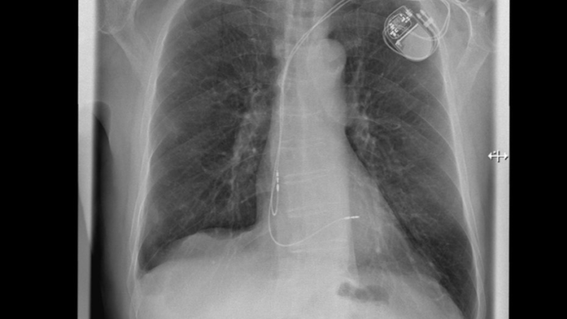 Kardiologie: Fakten zur minimalinvasiven Herzklappenintervention