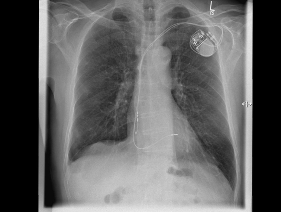 Kardiologie: Fakten zur minimalinvasiven Herzklappenintervention