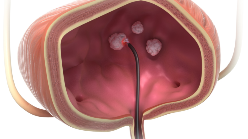 Diagnose Blasentumor: Frauen zunehmend betroffen – Schonende Entfernung mit neuer TULA-Lasertherapie