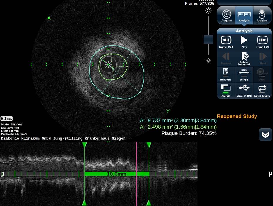 Kardiologie: Studie vergleicht CTO und OMT