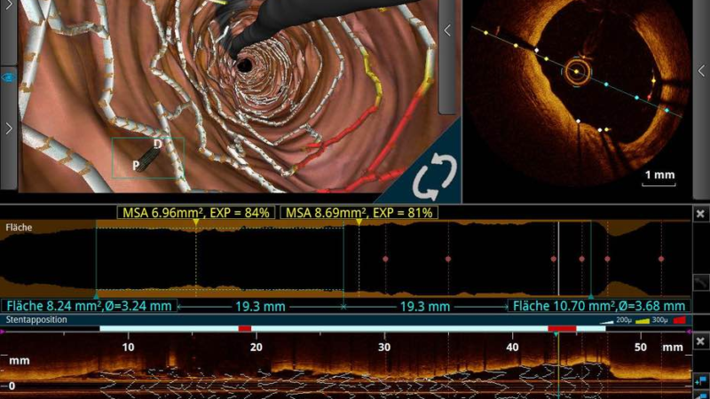 Kardiologie: Mitraclip-Patienten brauchen enge Nachsorge