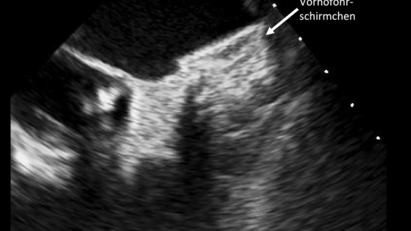 Vorhofflimmerablation oder abwarten – Kardiologe informiert