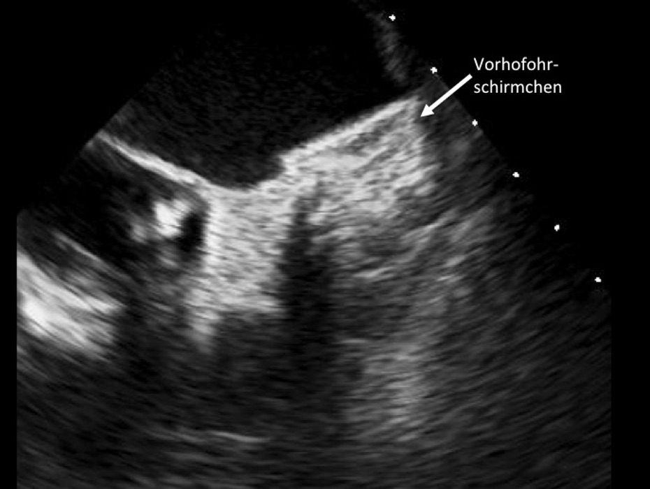 Vorhofflimmerablation oder abwarten – Kardiologe informiert