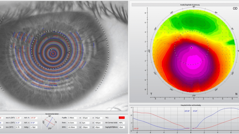 Keratokonus – krankhafte kegelförmige Vorwölbung der Hornhaut