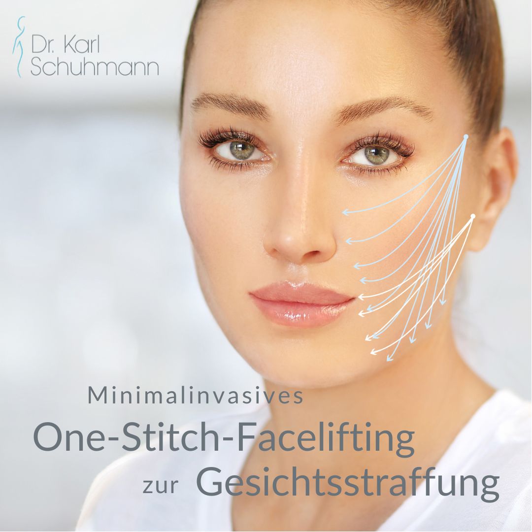 One-Stitch Facelifting – Zukunft der Gesichtsstraffung