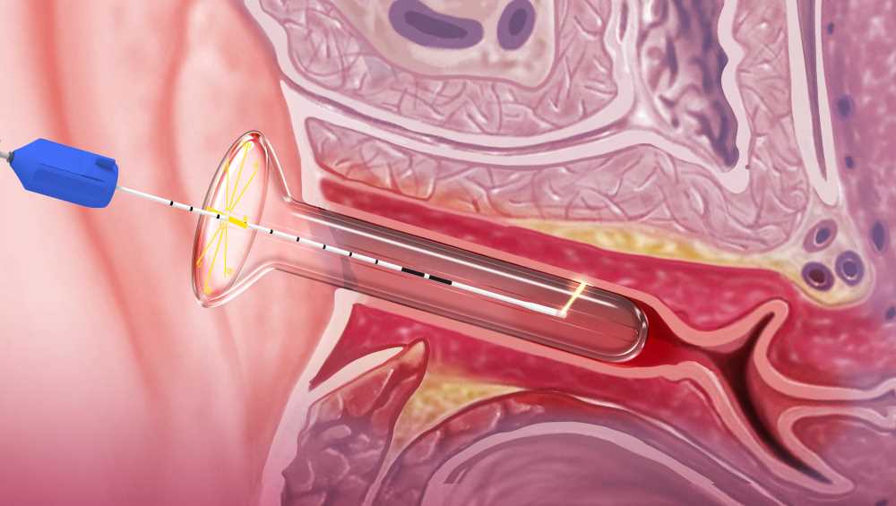 Leonardo dual diode laser effective for genitourinary syndrome of menopause