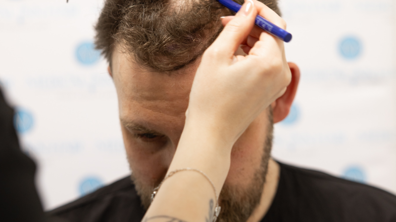 Haartransplantation Düsseldorf